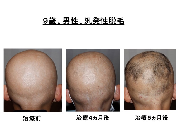 円形脱毛症　病院